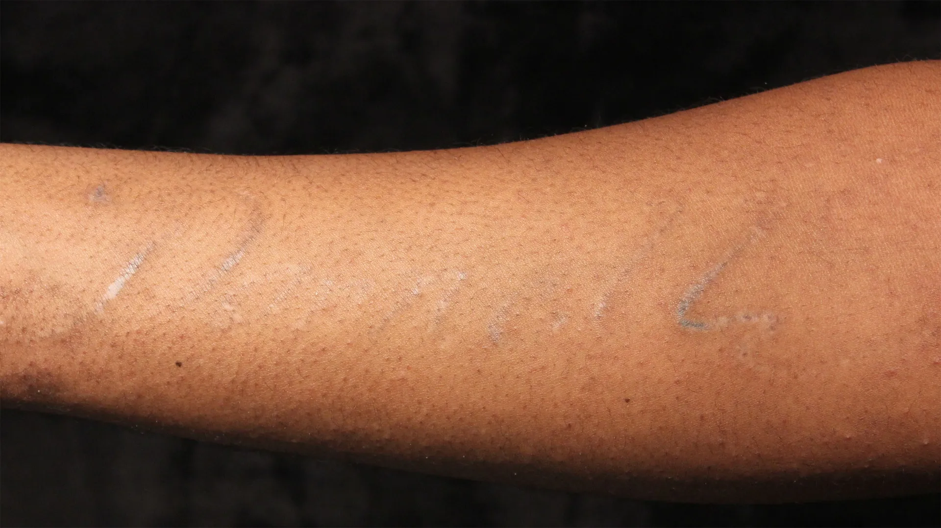 Script Text — tattoo removal result after 8 sessions