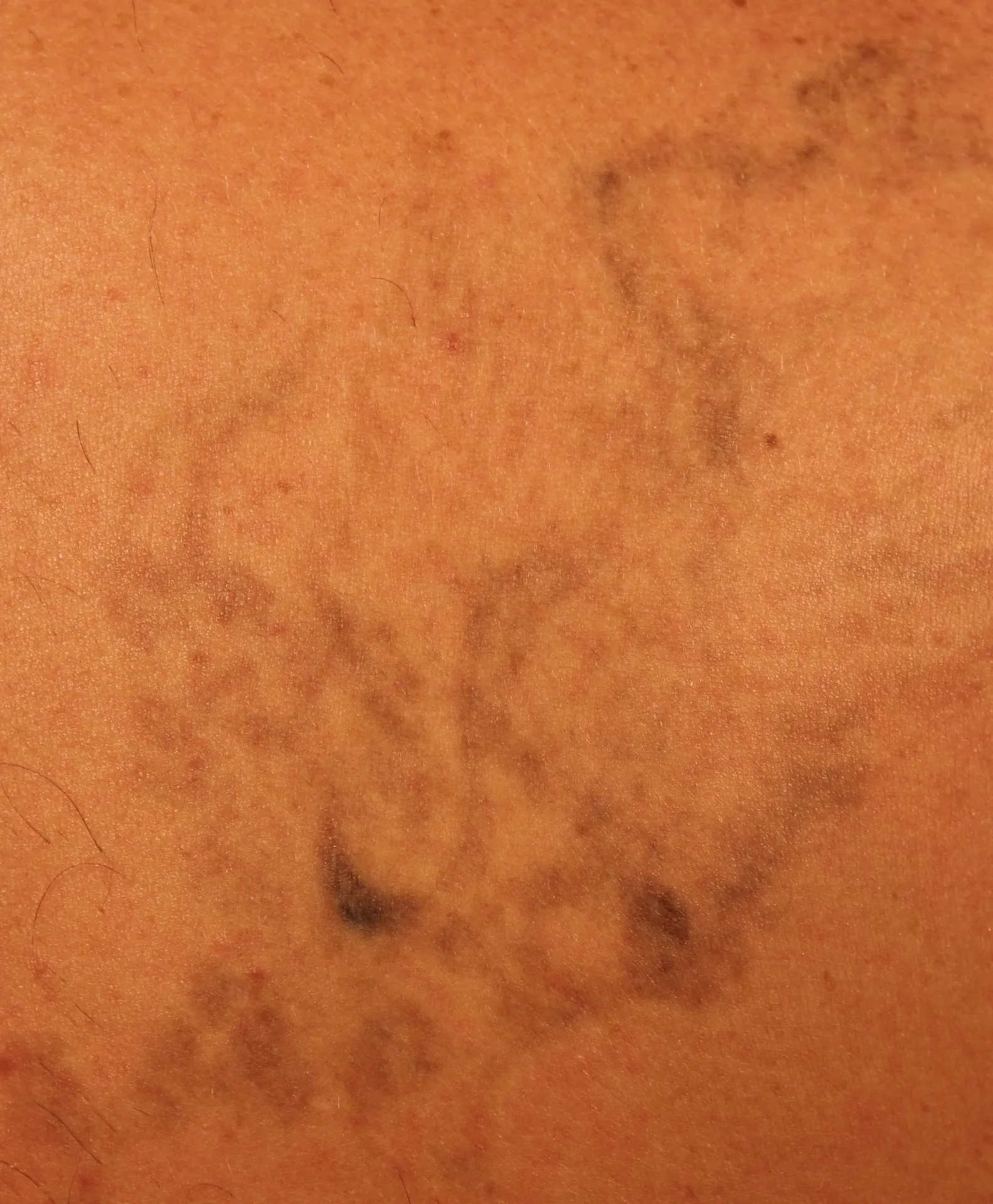 Wing Design — tattoo removal result after 7 sessions