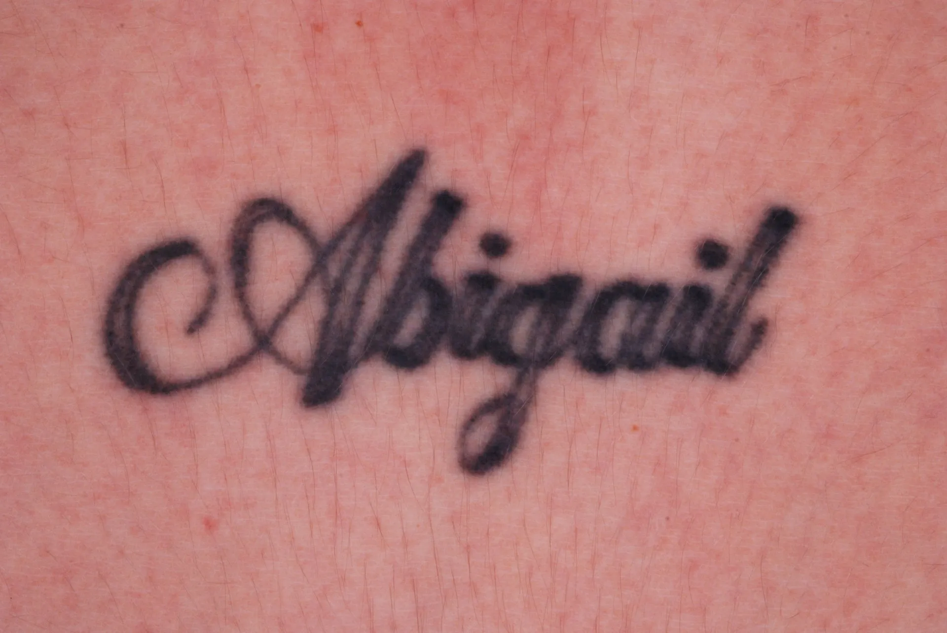Script Name — tattoo before laser removal treatment
