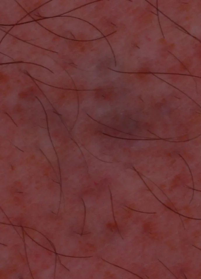 Amateur Ink — tattoo removal result after 2 sessions