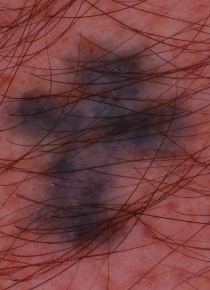 Amateur Ink — tattoo before laser removal treatment