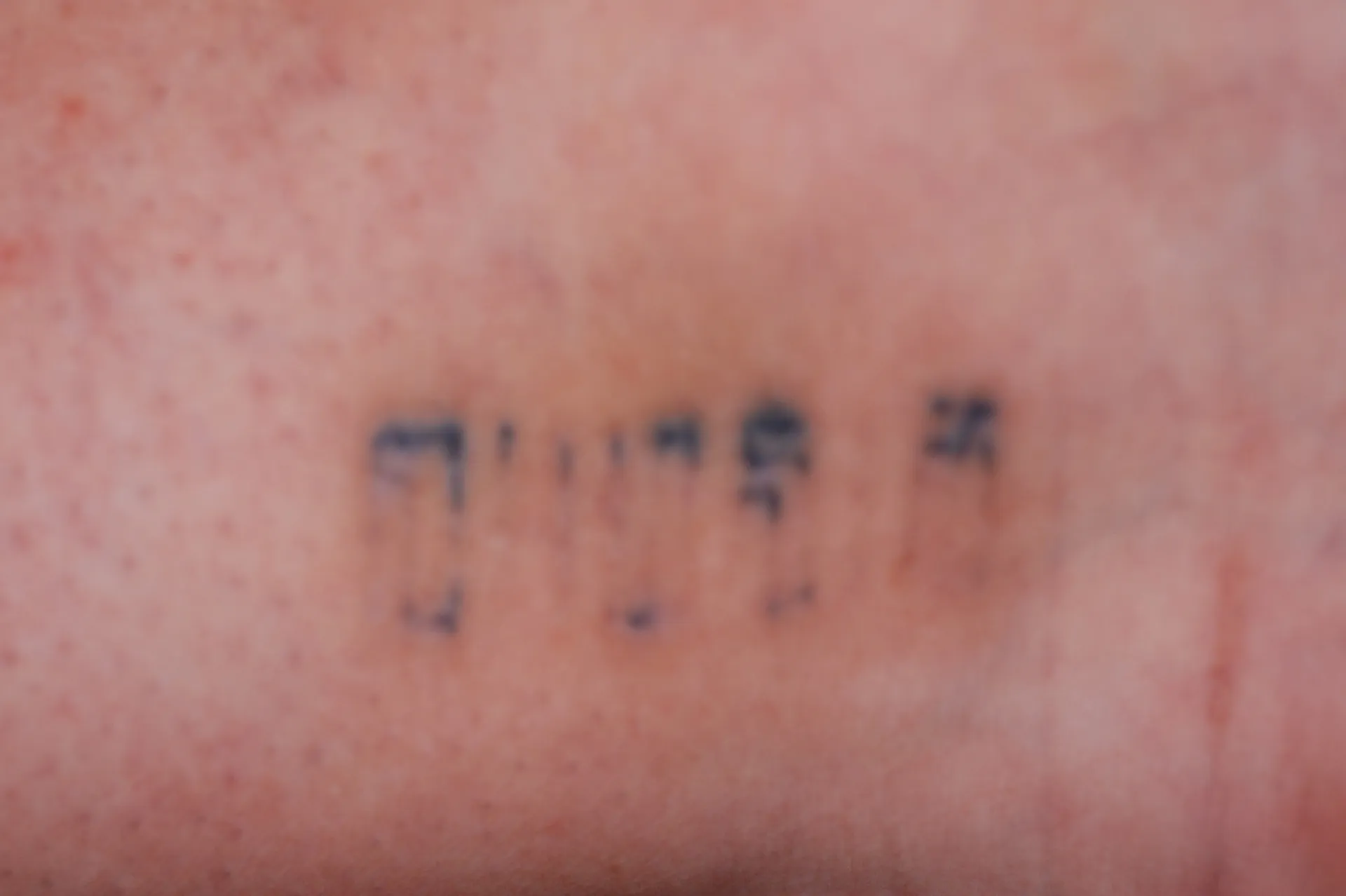 Barcode Text — tattoo removal result after 6 sessions