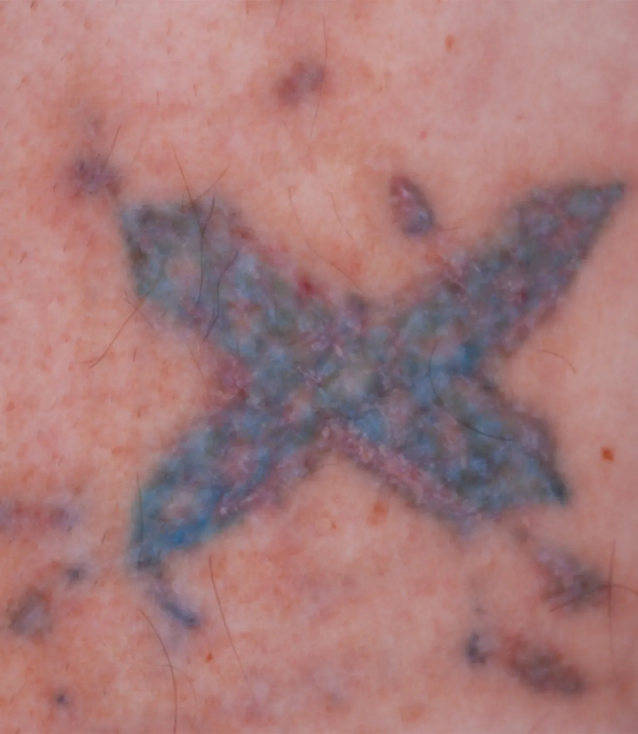 Blue Star Cross — tattoo removal result after 6 sessions