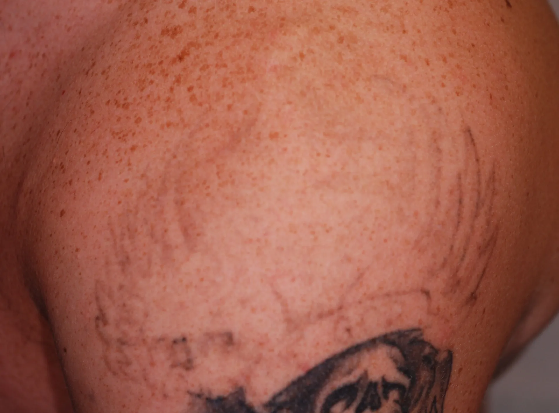 Cross & Wings — tattoo removal result after 5 sessions