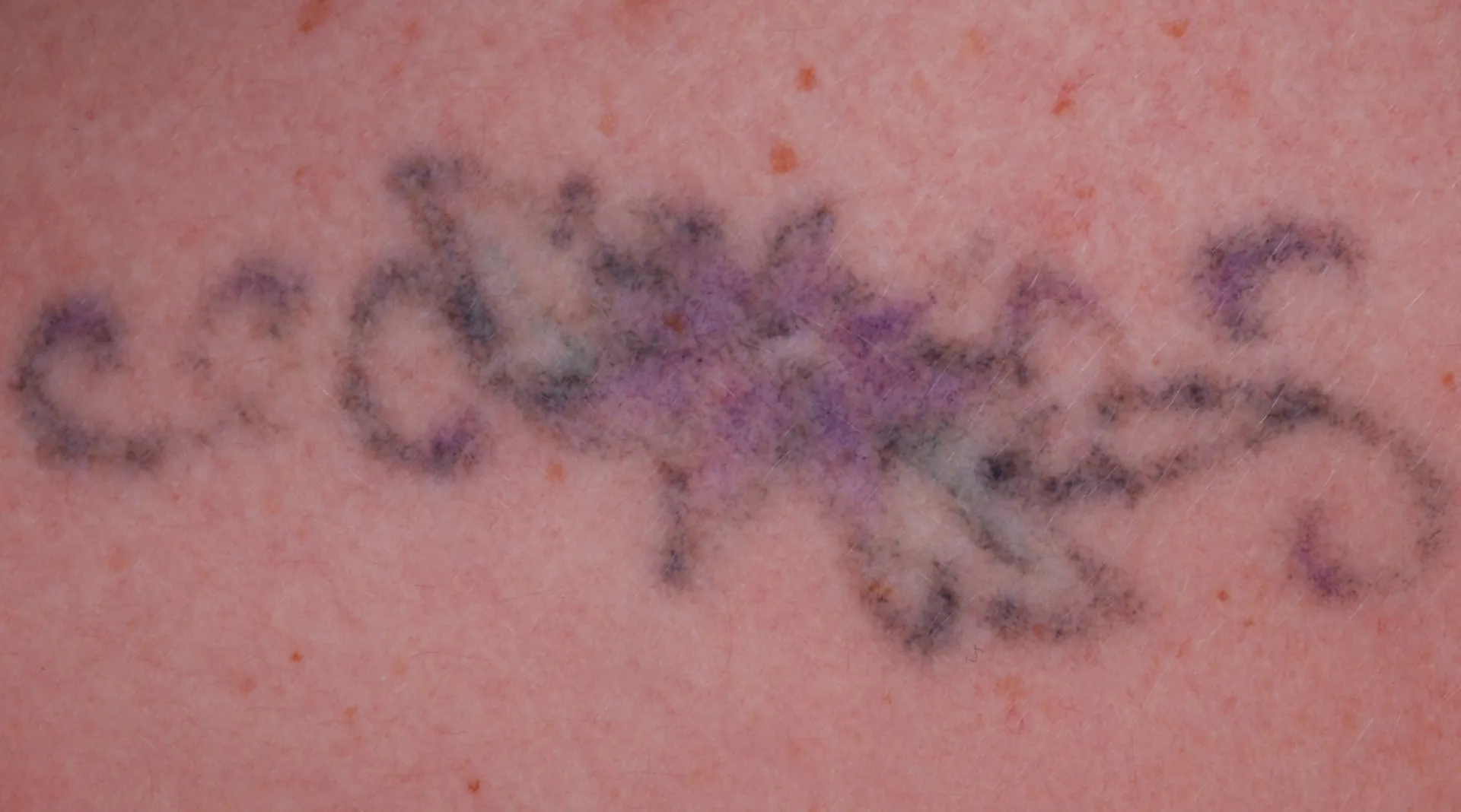 Floral Design — tattoo removal result after 1 sessions