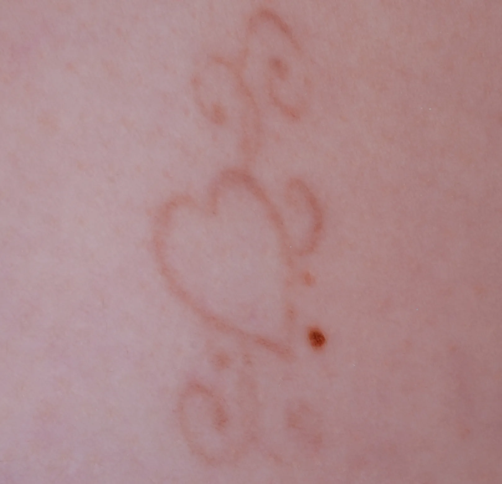 Decorative Heart — tattoo removal result after 6 sessions