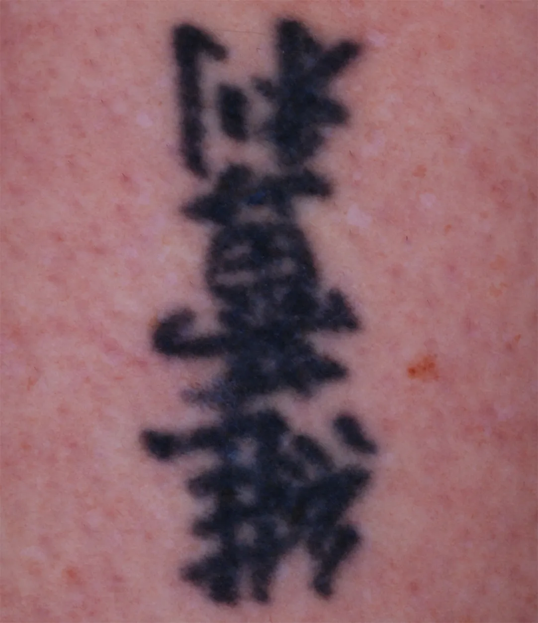 Chinese Characters — tattoo before laser removal treatment