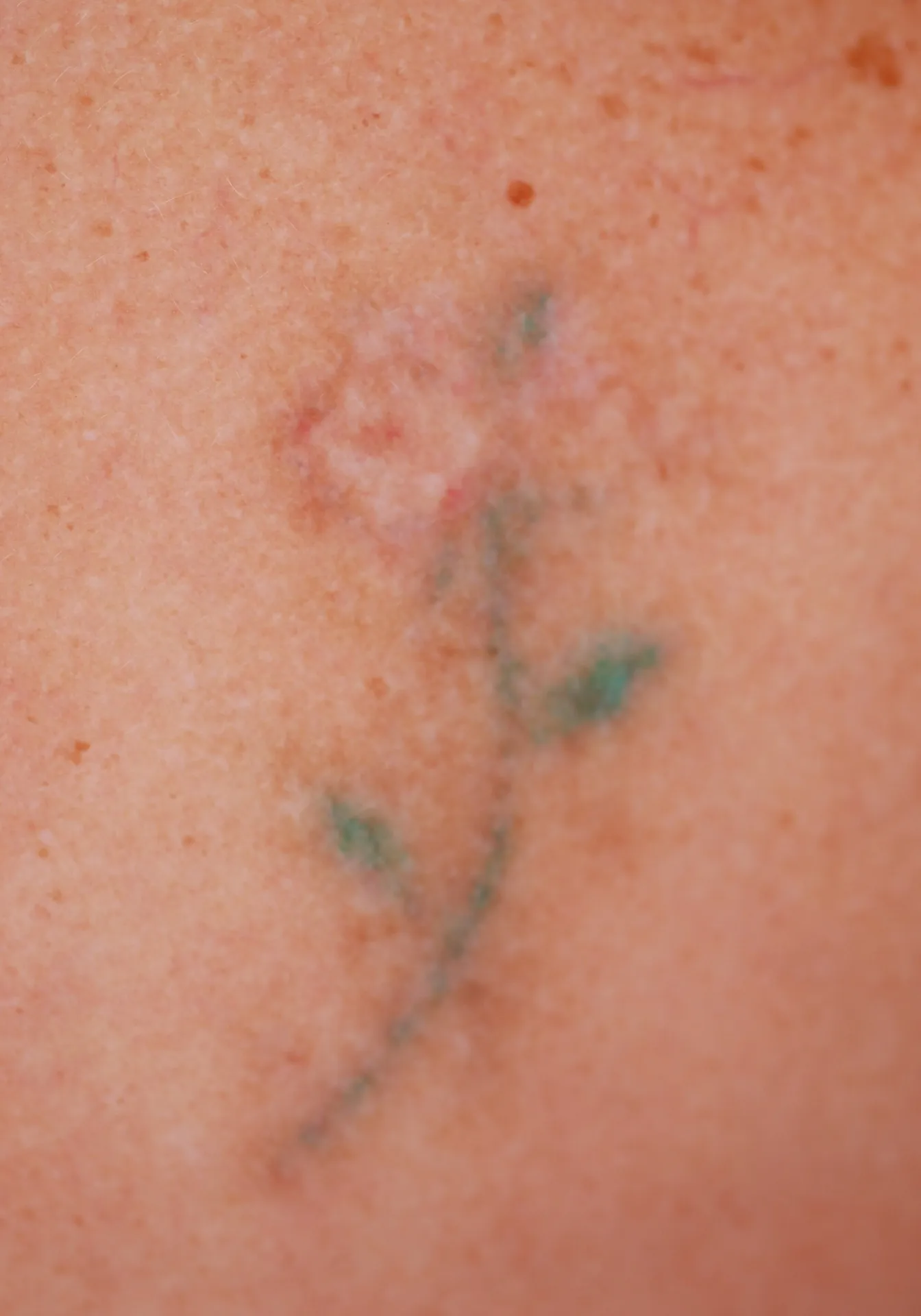 Coloured Rose — tattoo removal result after 5 sessions