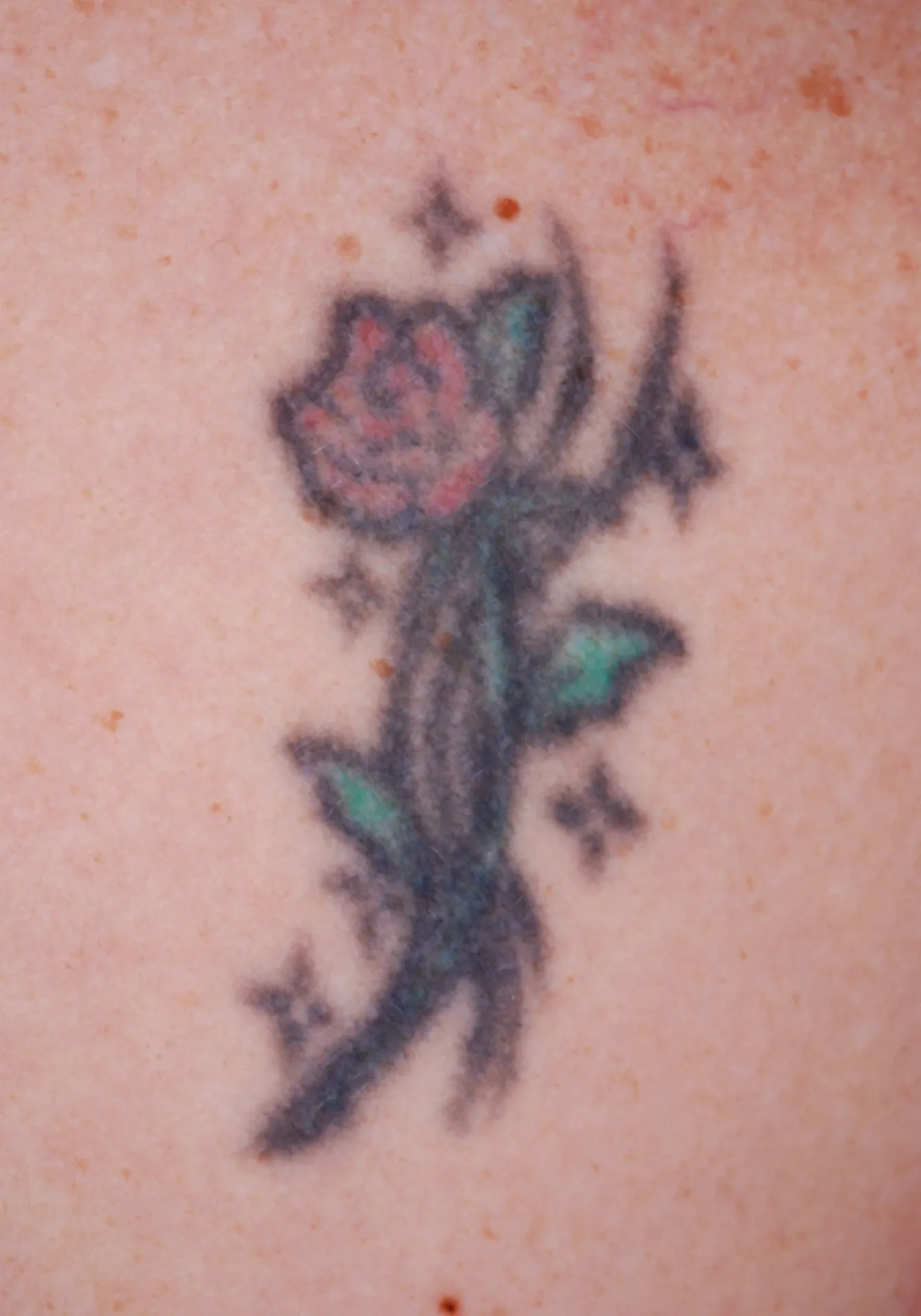 Coloured Rose — tattoo before laser removal treatment