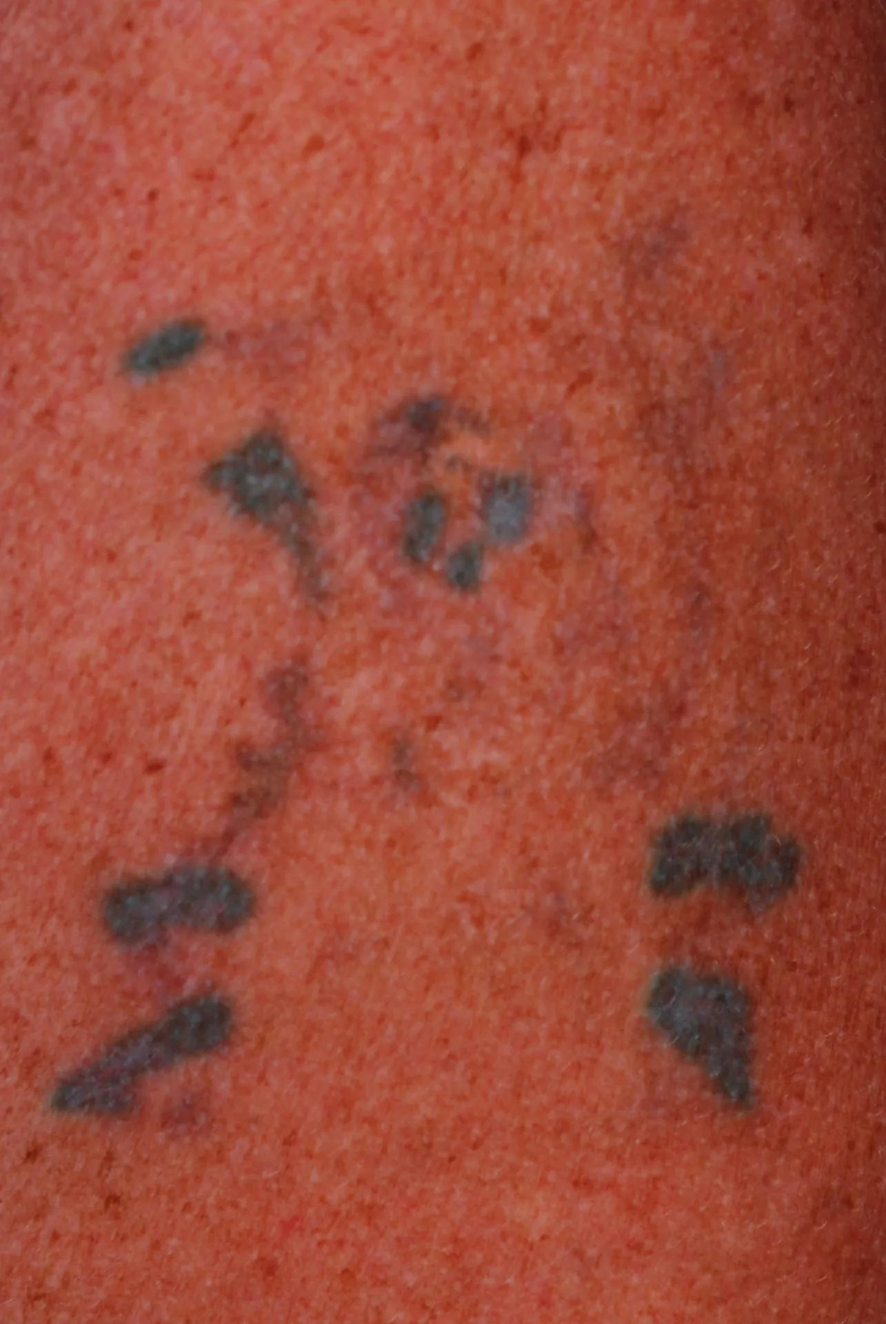 Skeleton Figure — tattoo removal result after 6 sessions