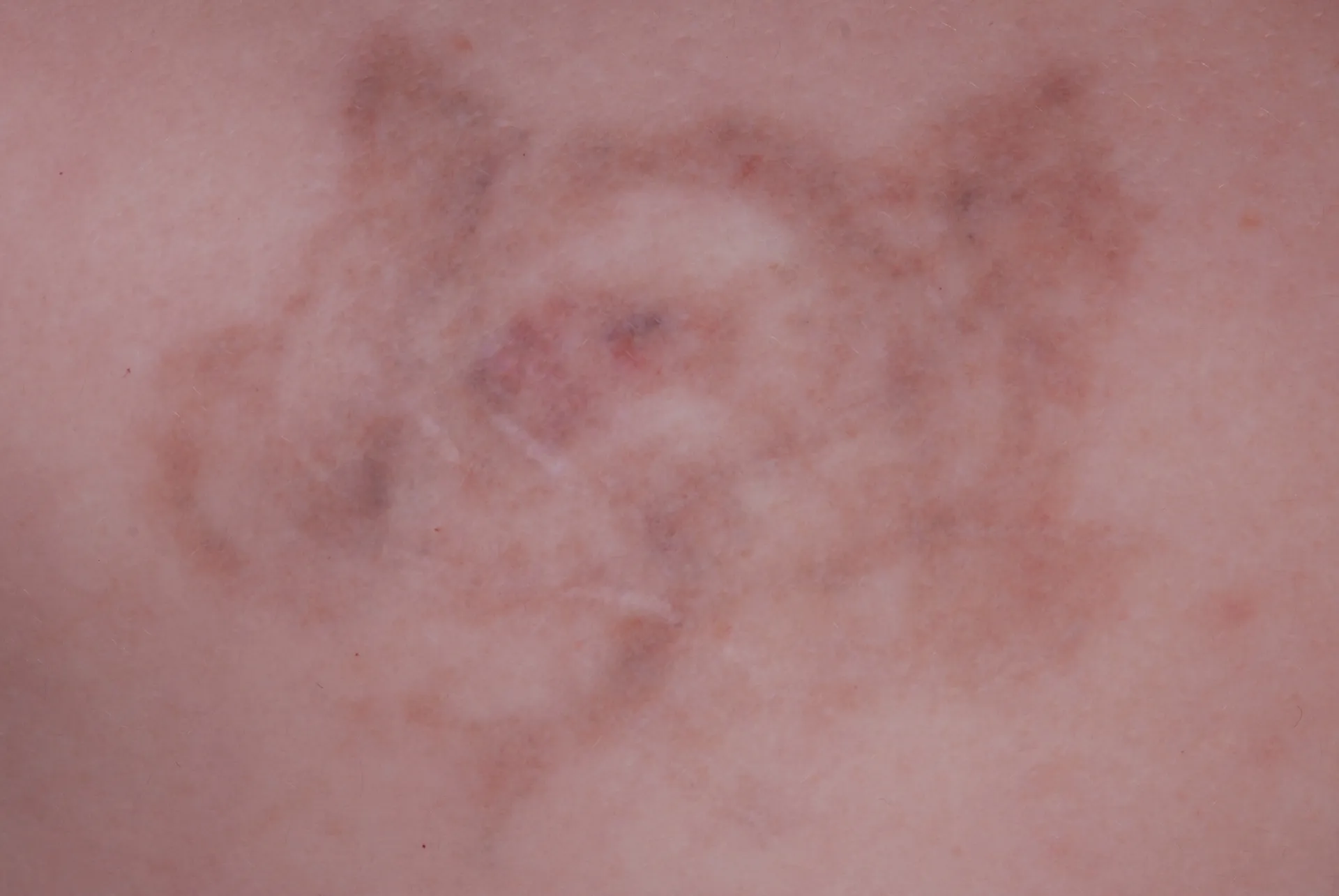 Skull with Wings — tattoo removal result after 5 sessions