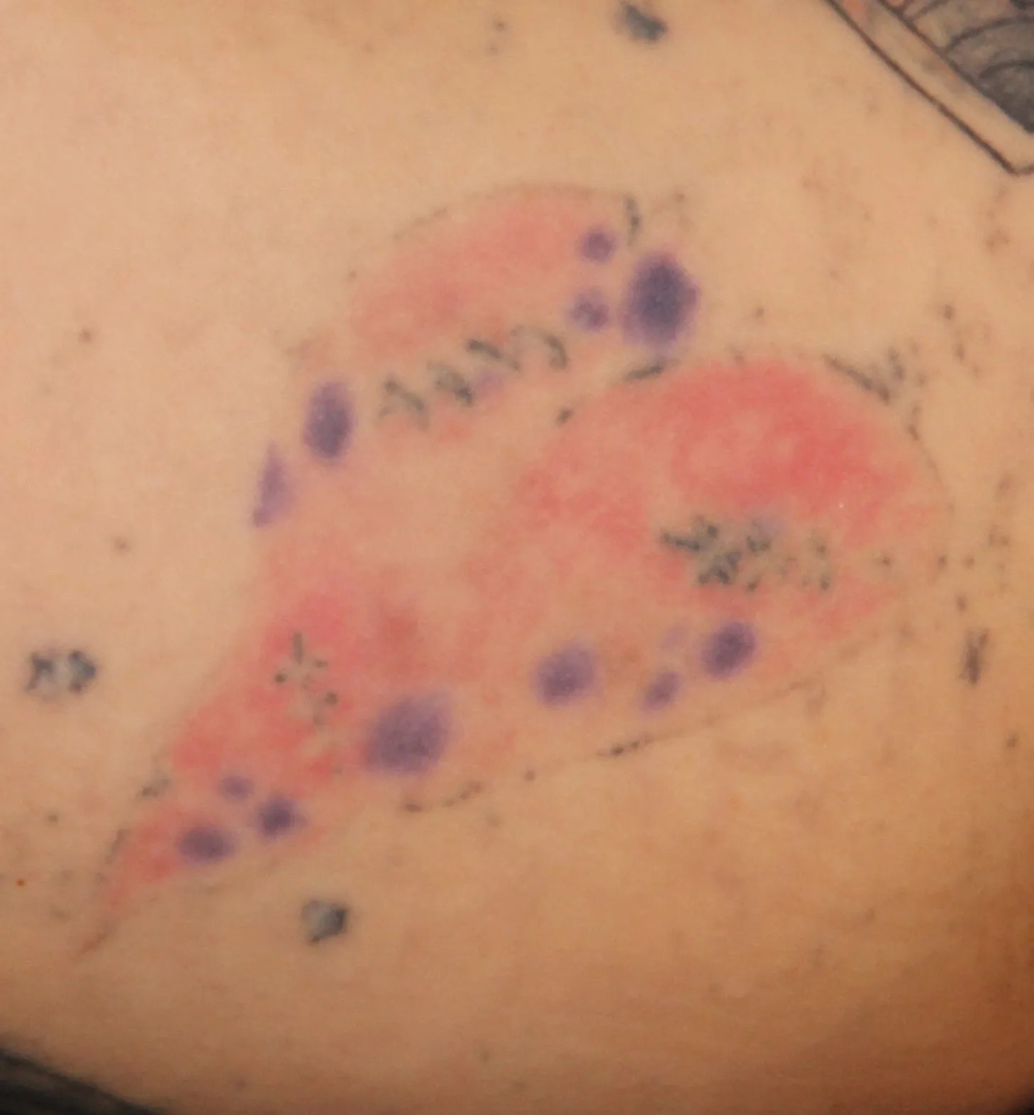 Coloured Footprints — tattoo before laser removal treatment