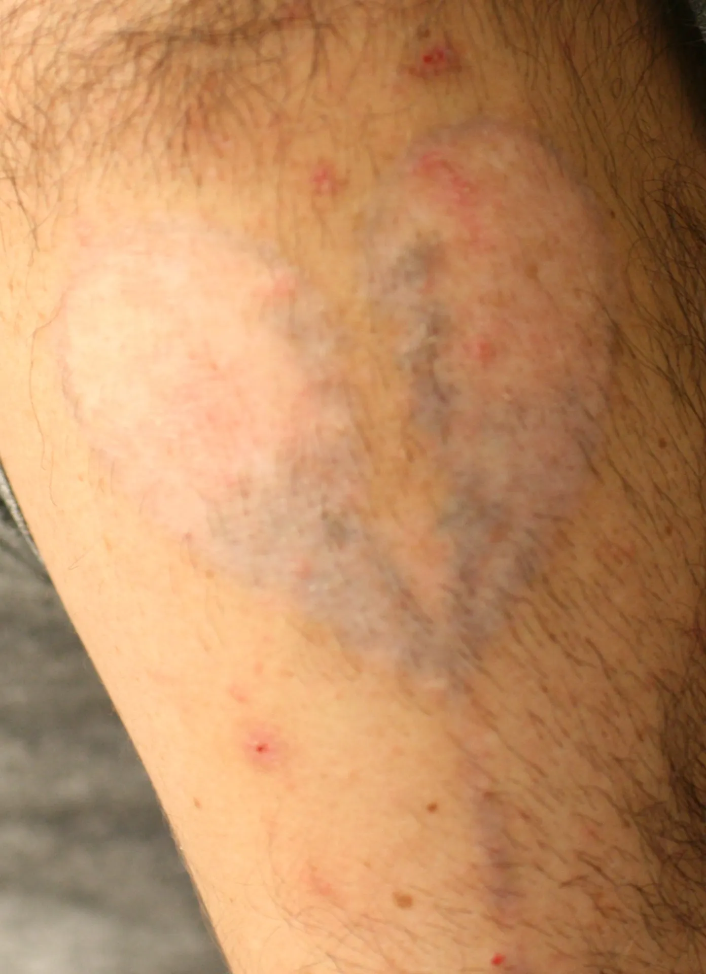 Heart with Red — tattoo removal result after 7 sessions