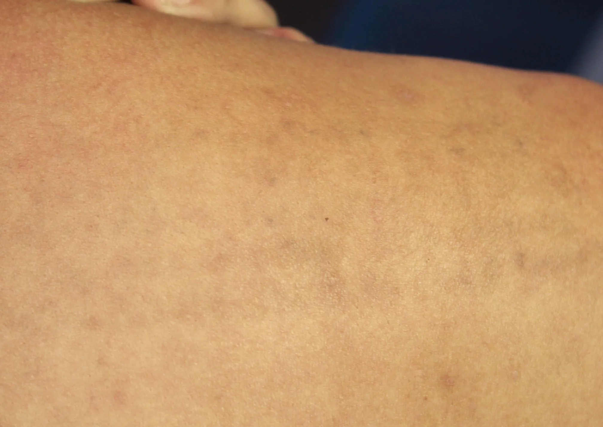 Text Quote — after laser tattoo removal