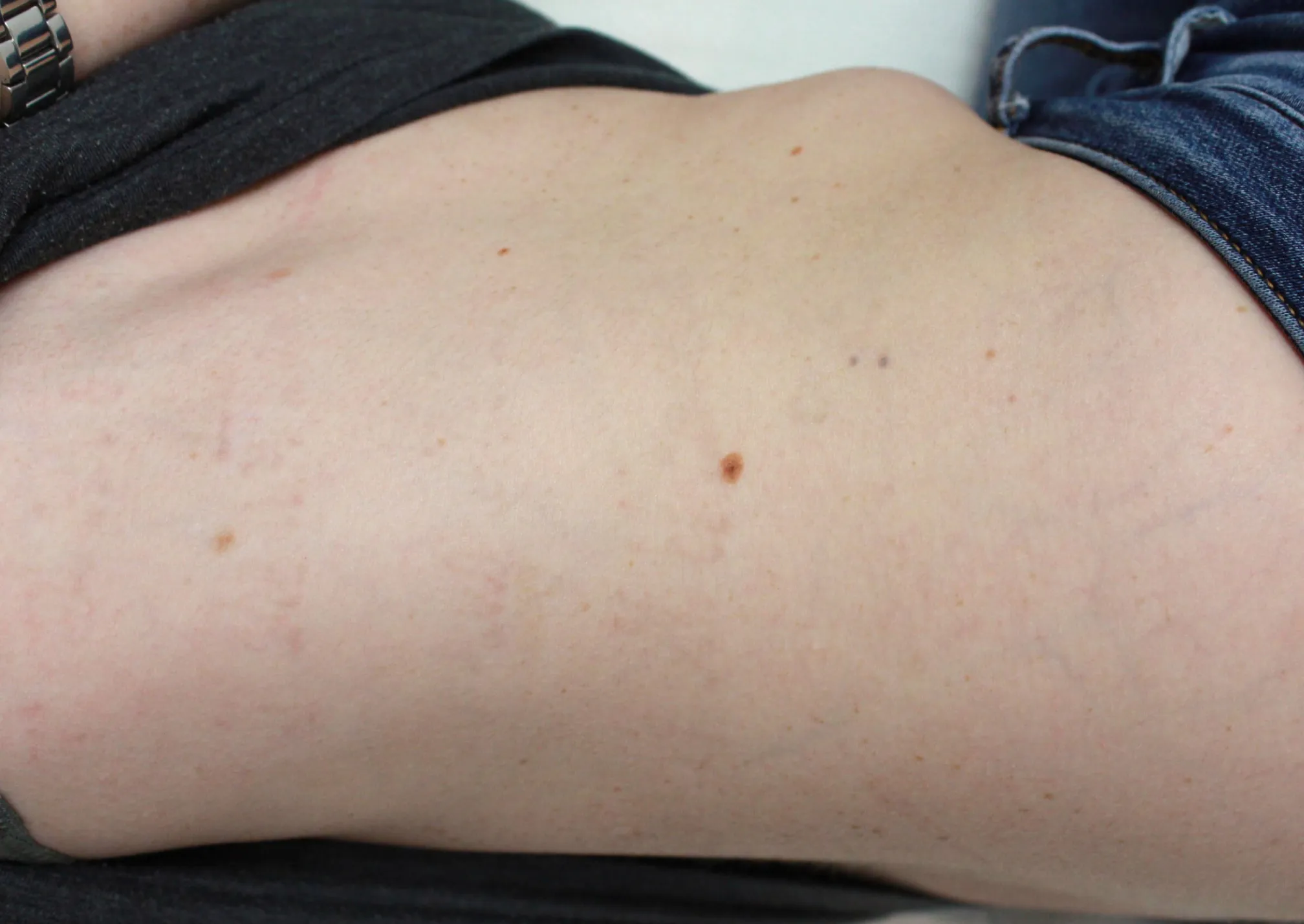 Cursive Script — after laser tattoo removal