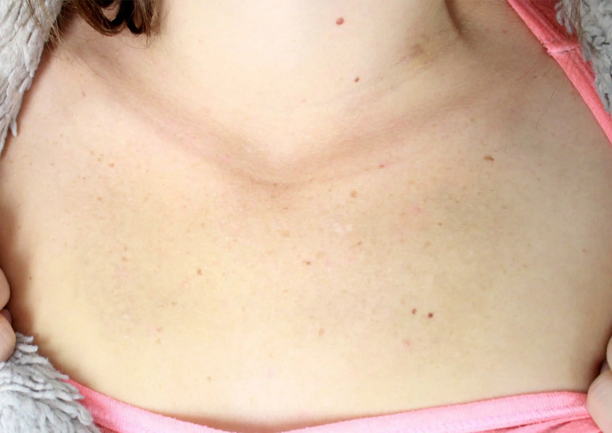 Memorial Wings — after laser tattoo removal