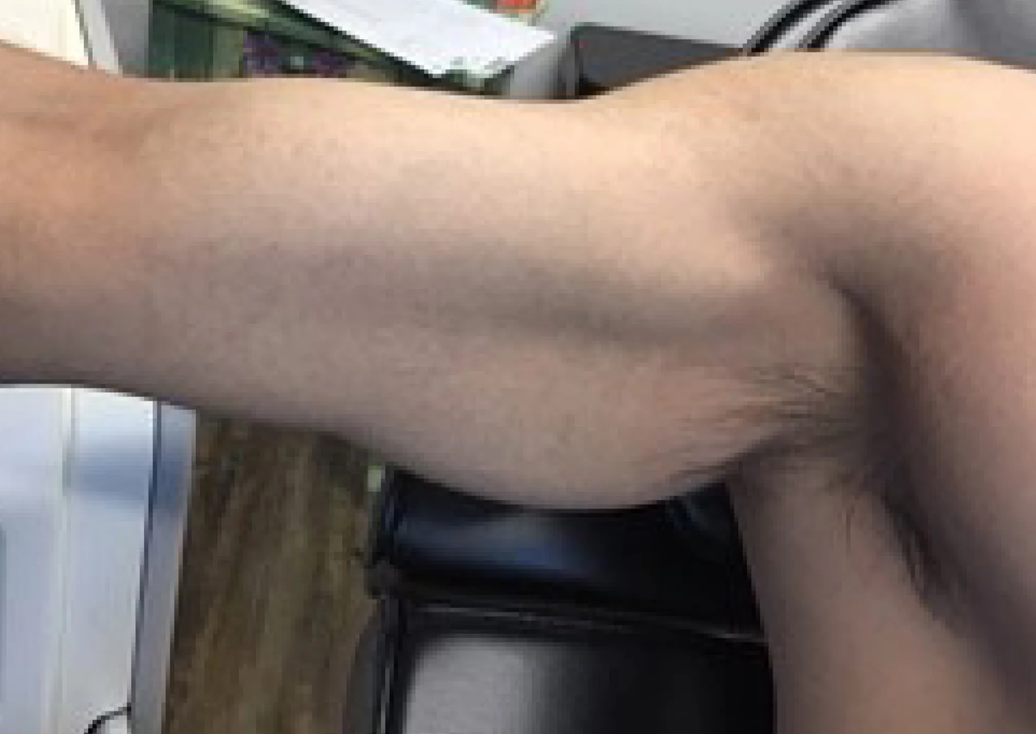 Arm Sleeve — after laser tattoo removal