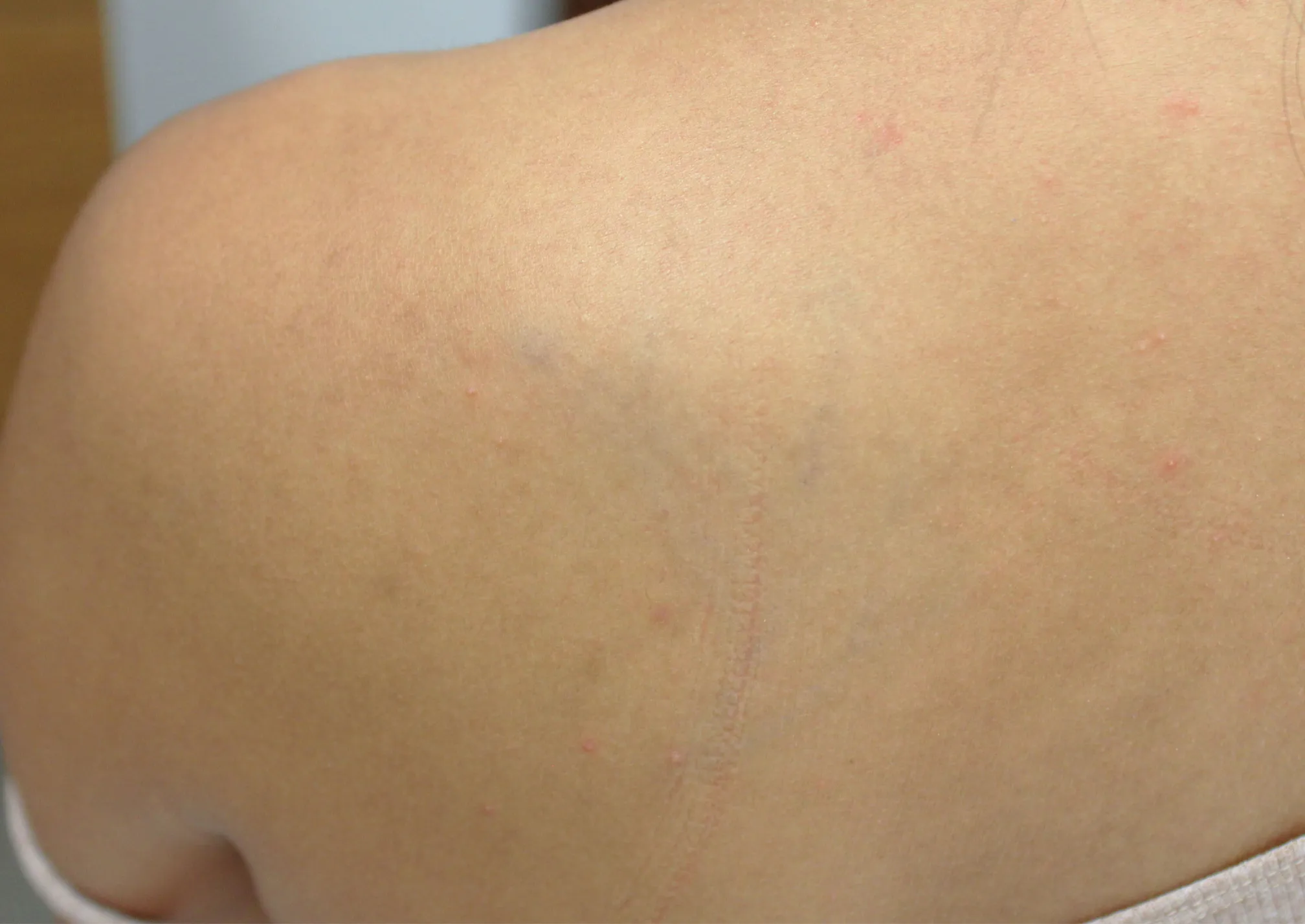 Tribal Design — after laser tattoo removal