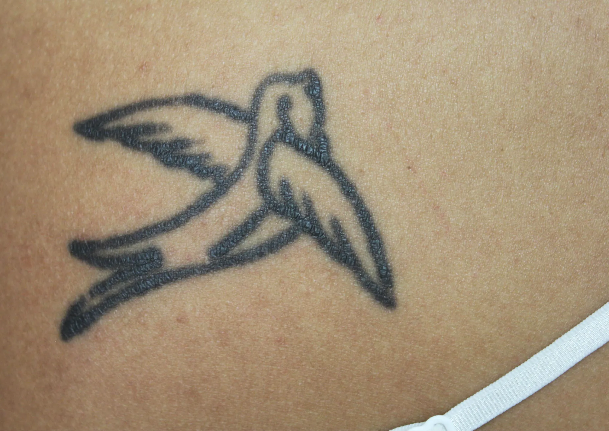 Tribal Design — before laser tattoo removal